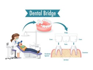 dental bridge cost in Hyderabad