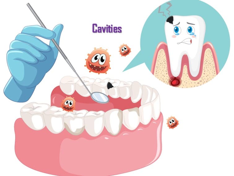 Are Cavities Bad – How to Prevent Them?
