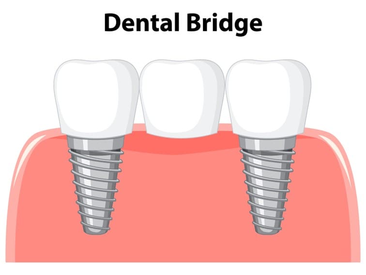 Dental Bridge – Types and Cost in Hyderabad