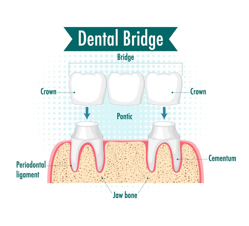 Dental Crowns and Bridges