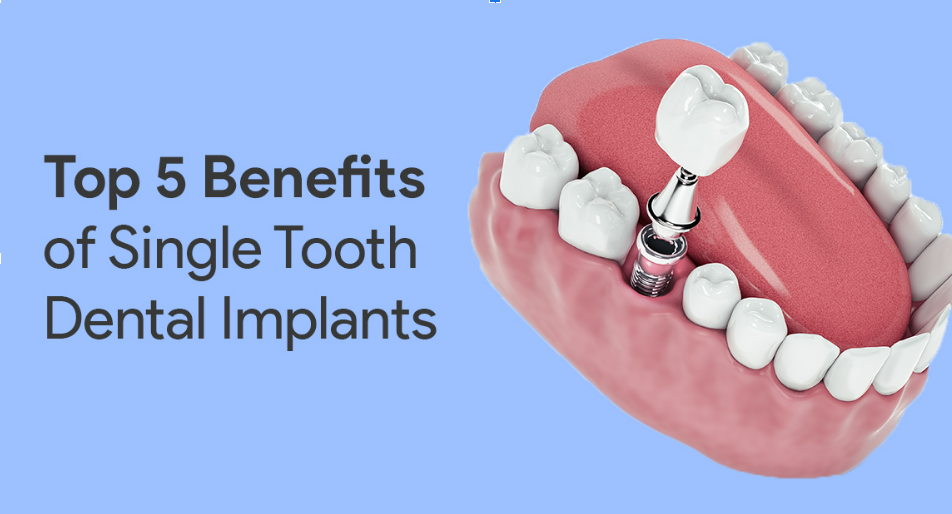 Top 5 Benefits Of Single-Tooth Dental Implants