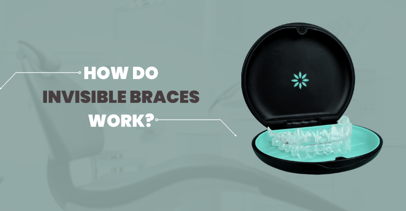 How Do Invisible Braces Work?