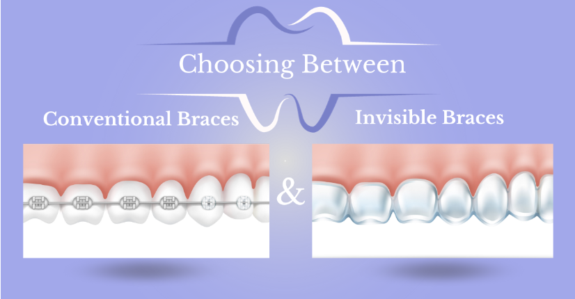 Choosing Between Conventional Braces & Invisible Braces