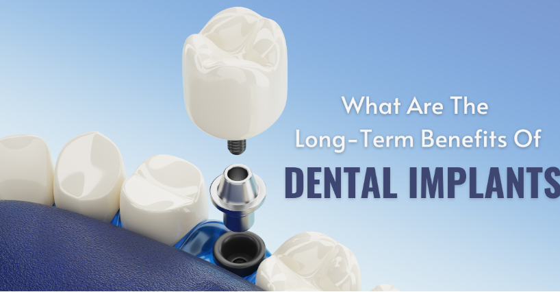 What Are The Long-Term Benefits of Dental Implants?
