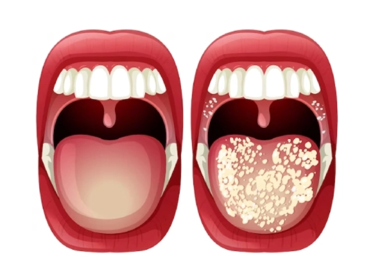 Dry Mouth Causes & Symptoms