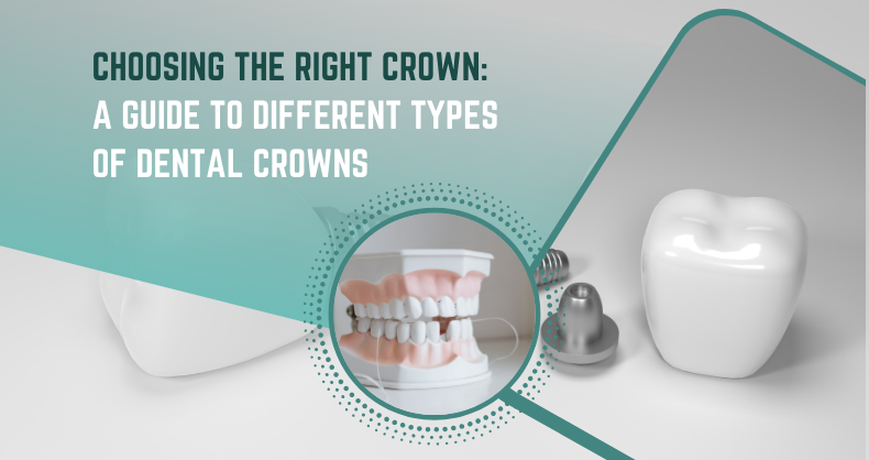 Choosing the Right Crown: A Guide to Different Types of Dental Crowns