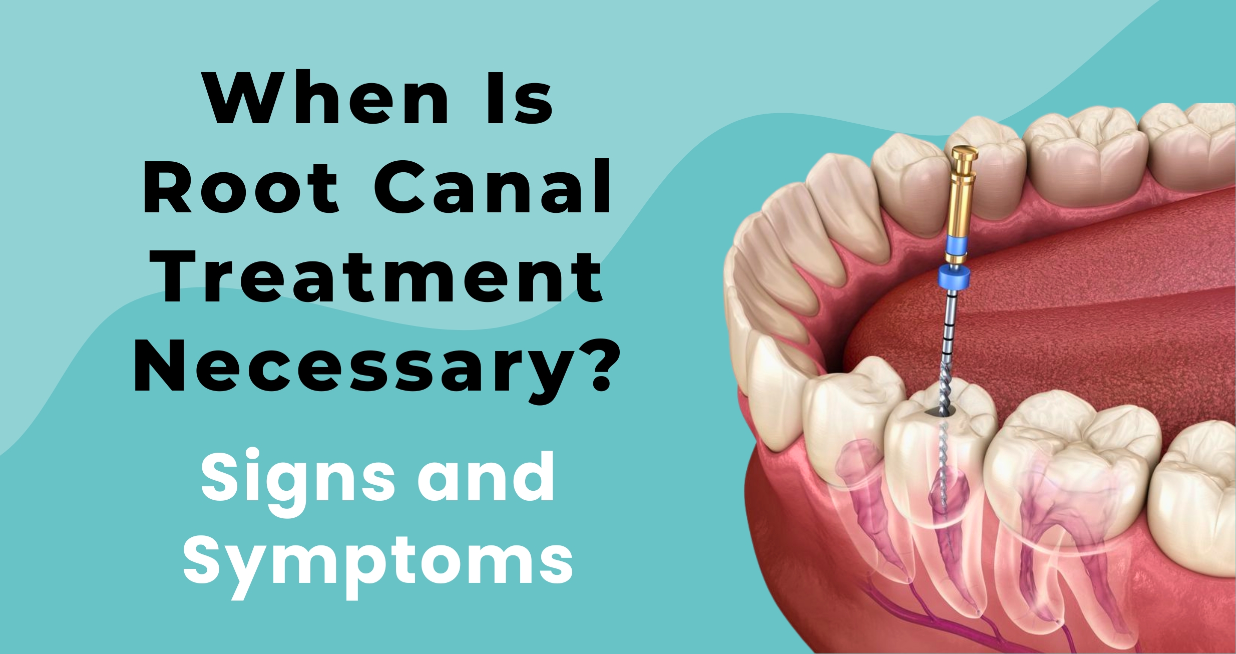 When Is Root Canal Treatment Necessary? Signs and Symptoms