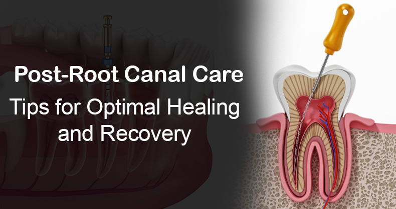 Post-Root Canal Care: Tips for Optimal Healing and Recovery