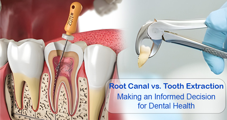 Root Canal vs Tooth Extraction: Making An Informed Decision For Dental Health
