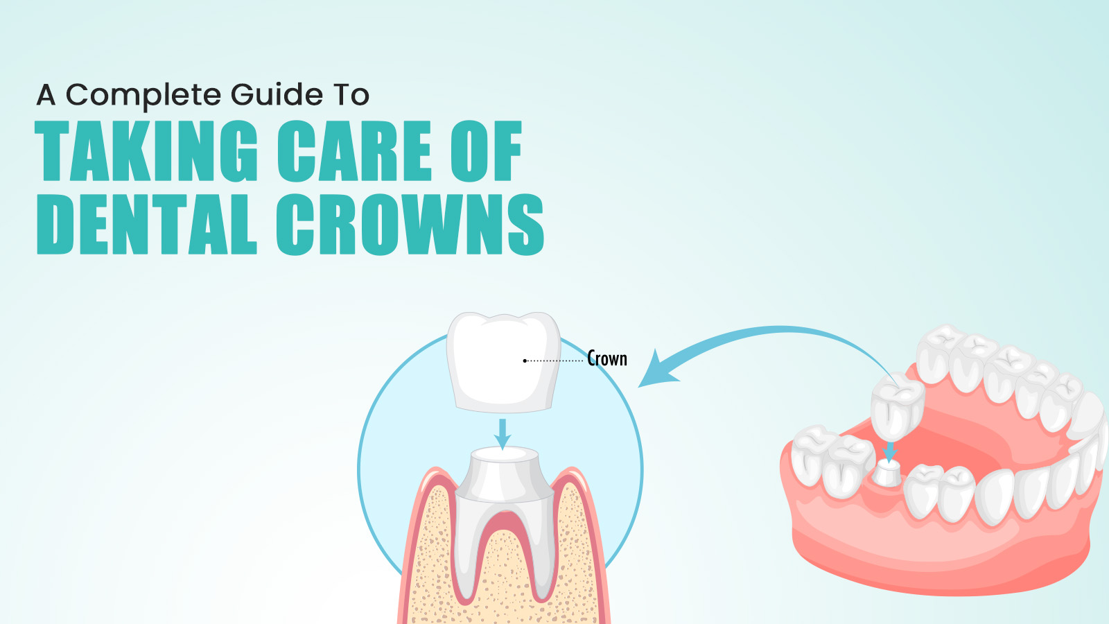 A Complete Guide To Taking Care Of Dental Crowns