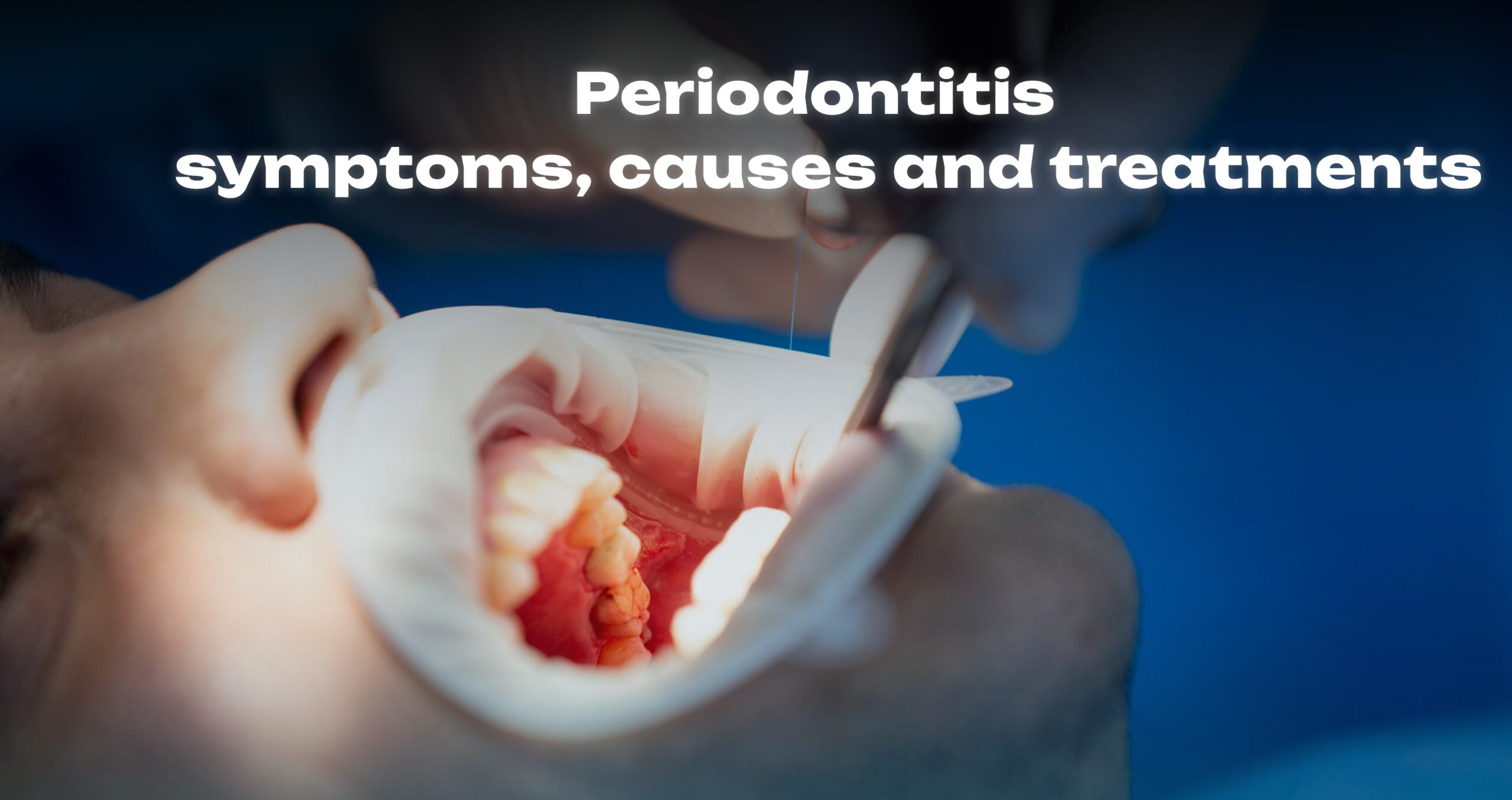 Periodontitis – Symptoms, Causes, and Treatments