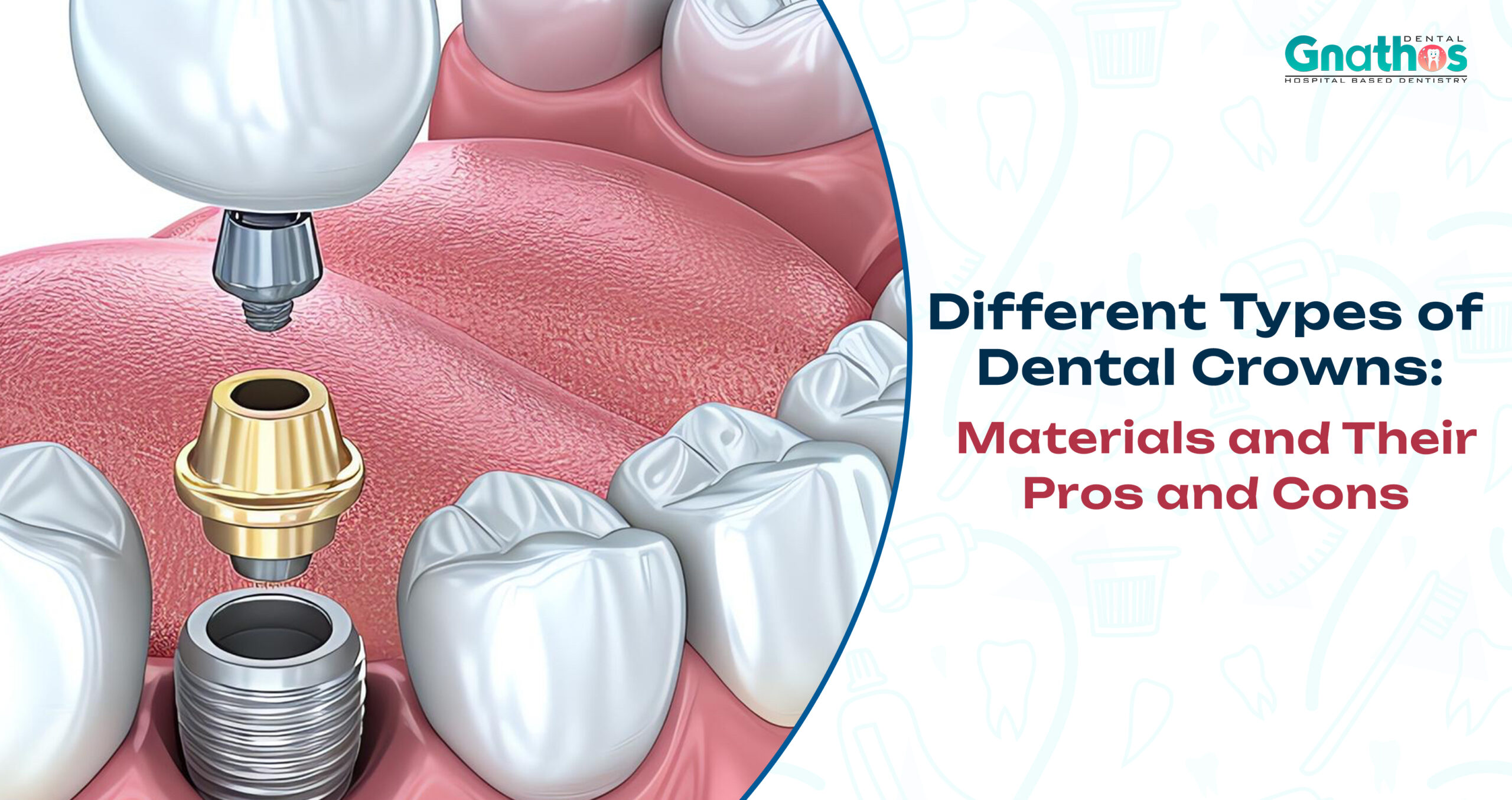 Different Types of Dental Crowns: Materials and Their Pros and Cons