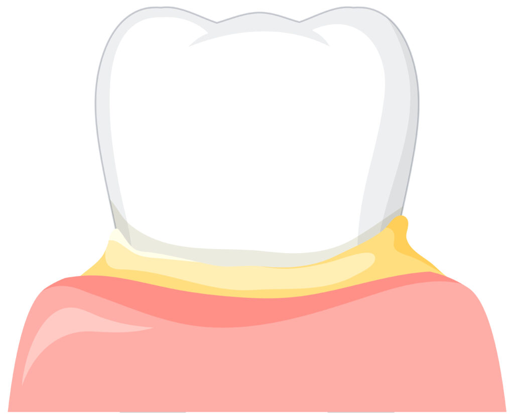 zirconia crowns-strong teeth-gnathos-dental