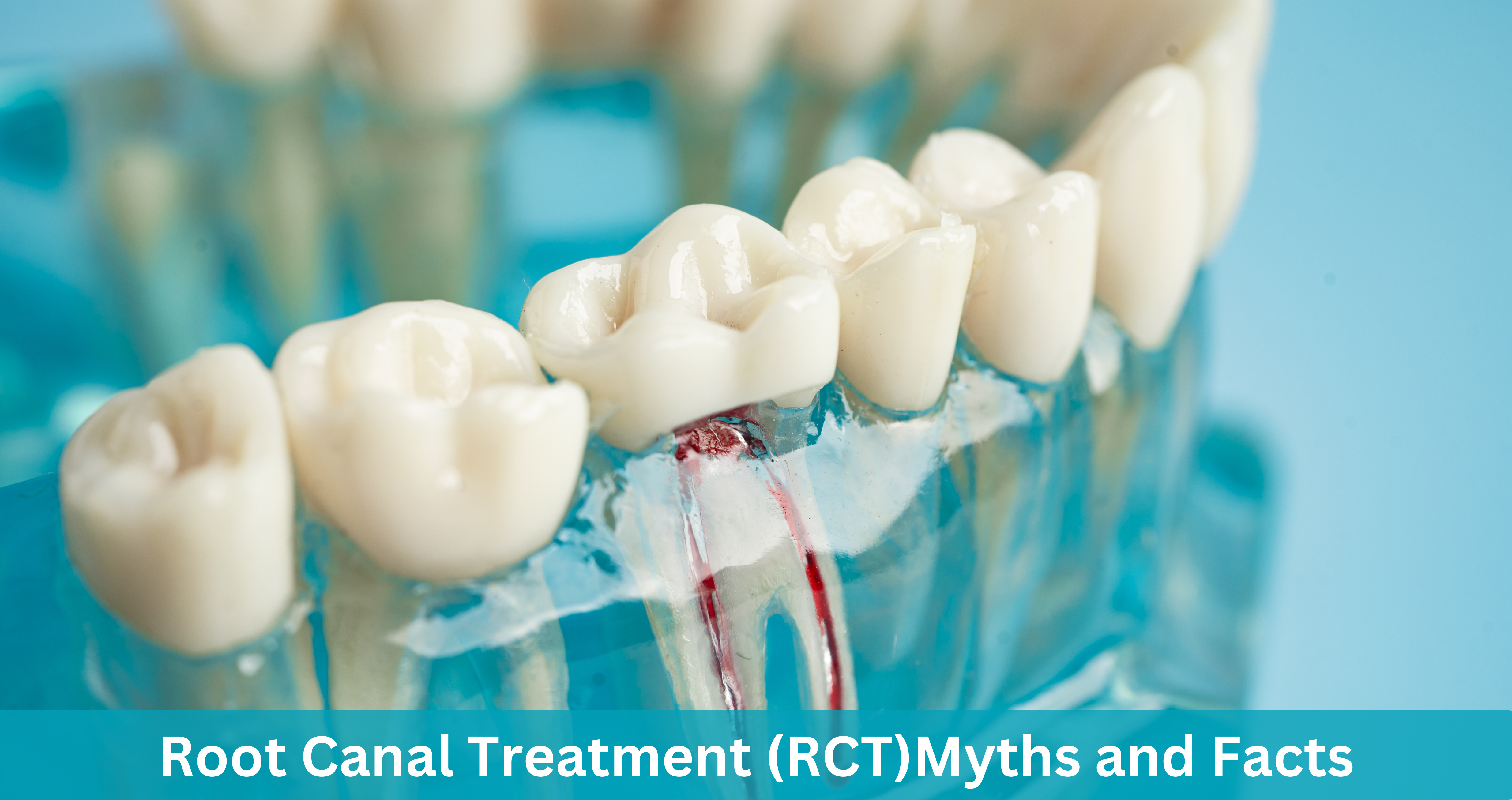 Root Canal Treatment (RCT) Myths and Facts